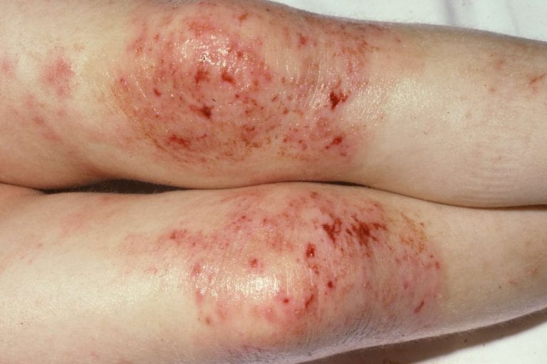 Dermatitele și eczemele