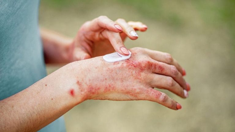Eczema (Dermatita atopică)