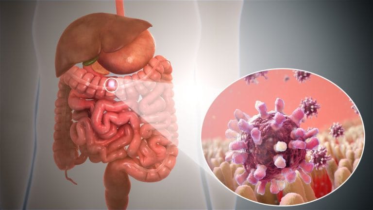 Infecțiile digestive (gastroenterite): simptome, cauze și tratament Infecțiile digestive (gastroenterite)