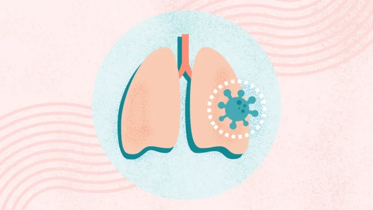 Pneumonia: Cauze, Simptome, Tratament și Prevenție Pneumonia