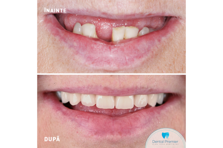 implant dentar in bucuresti la dental premier